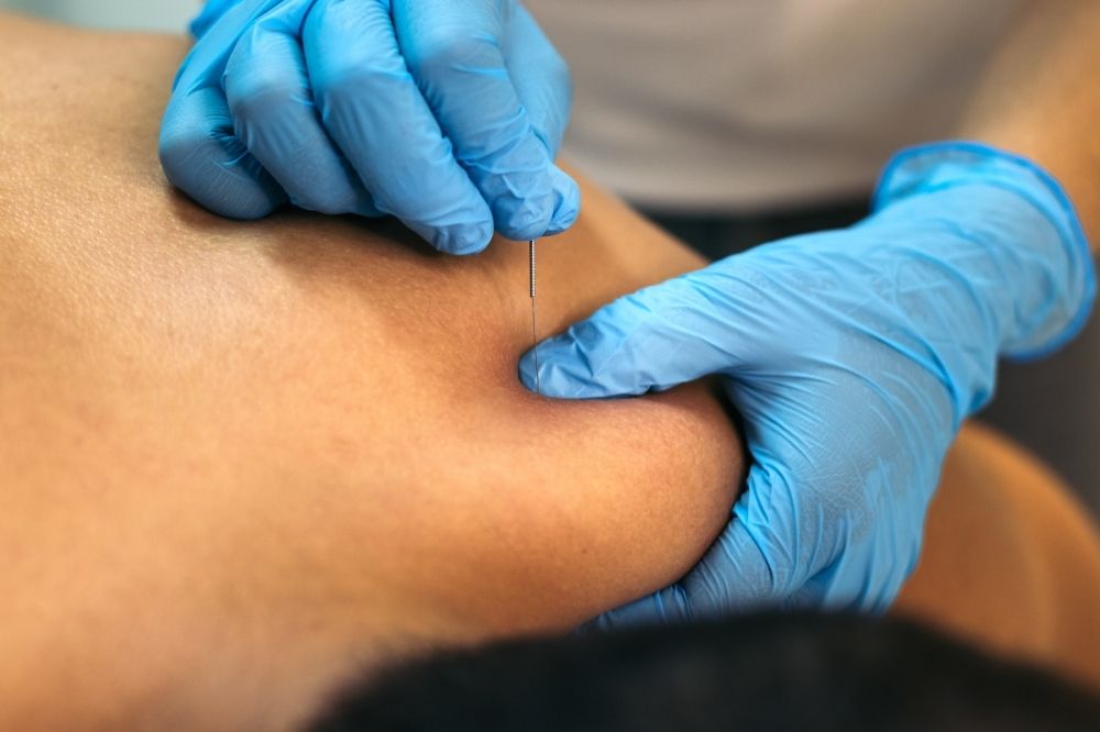Tratamiento de punción seca en fisioterapia