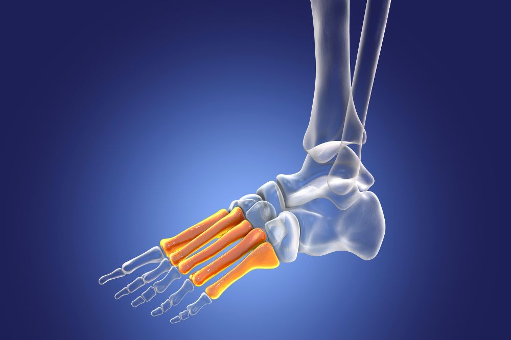 dolor pie lateral externo metatarso
